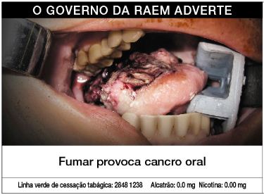 Macau 2013 Health Effects mouth - oral cancer, gross (Portuguese)